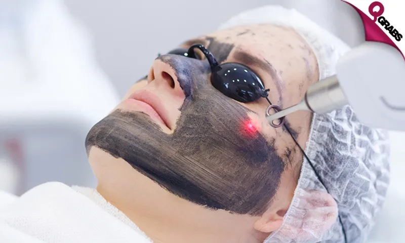 Carbon Laser Treatment!